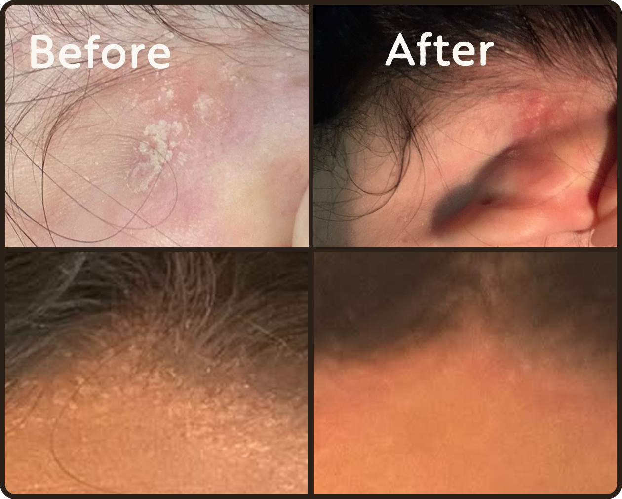Before and after close-ups of skin near the hairline