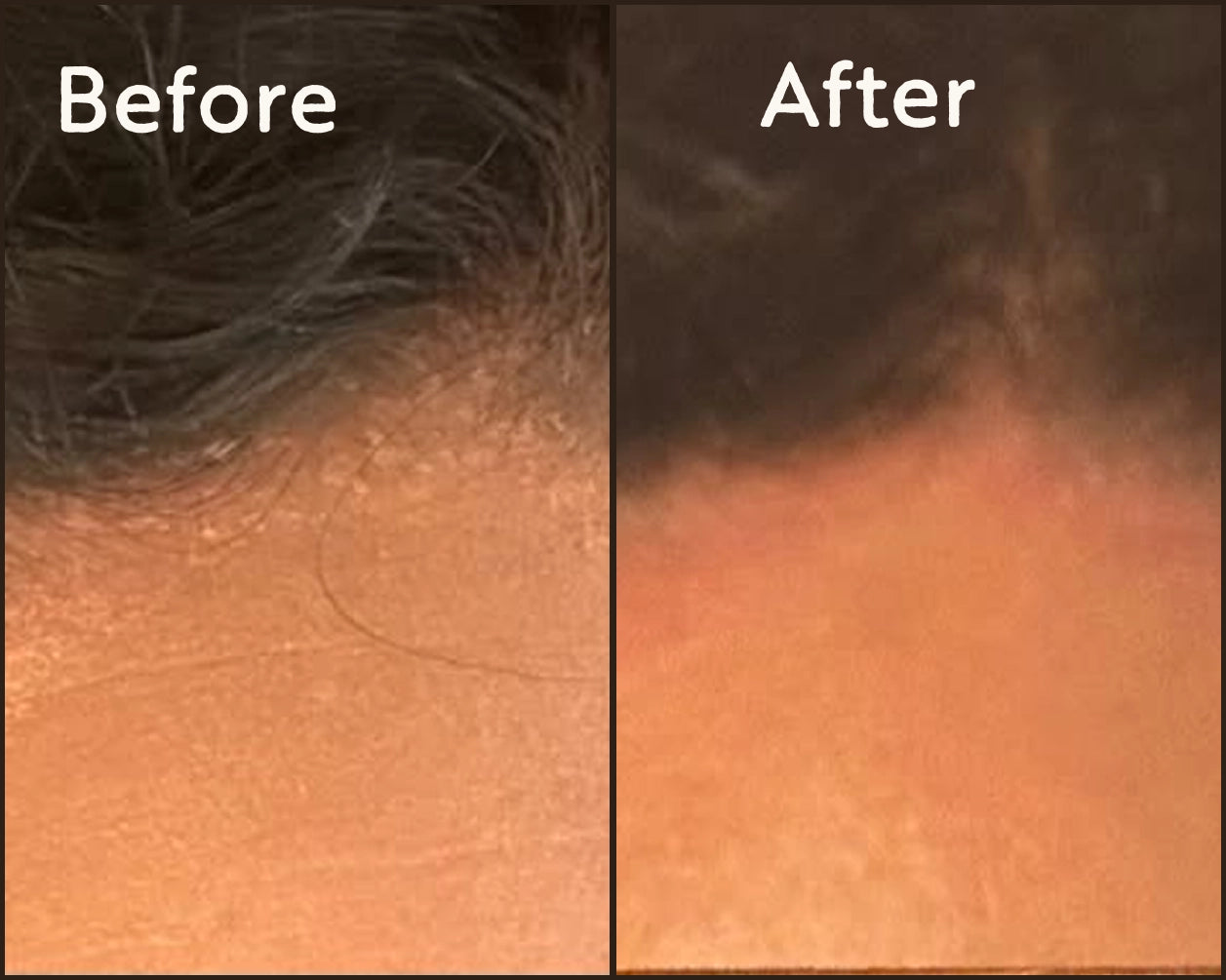 Before and after close-ups of forehead skin
