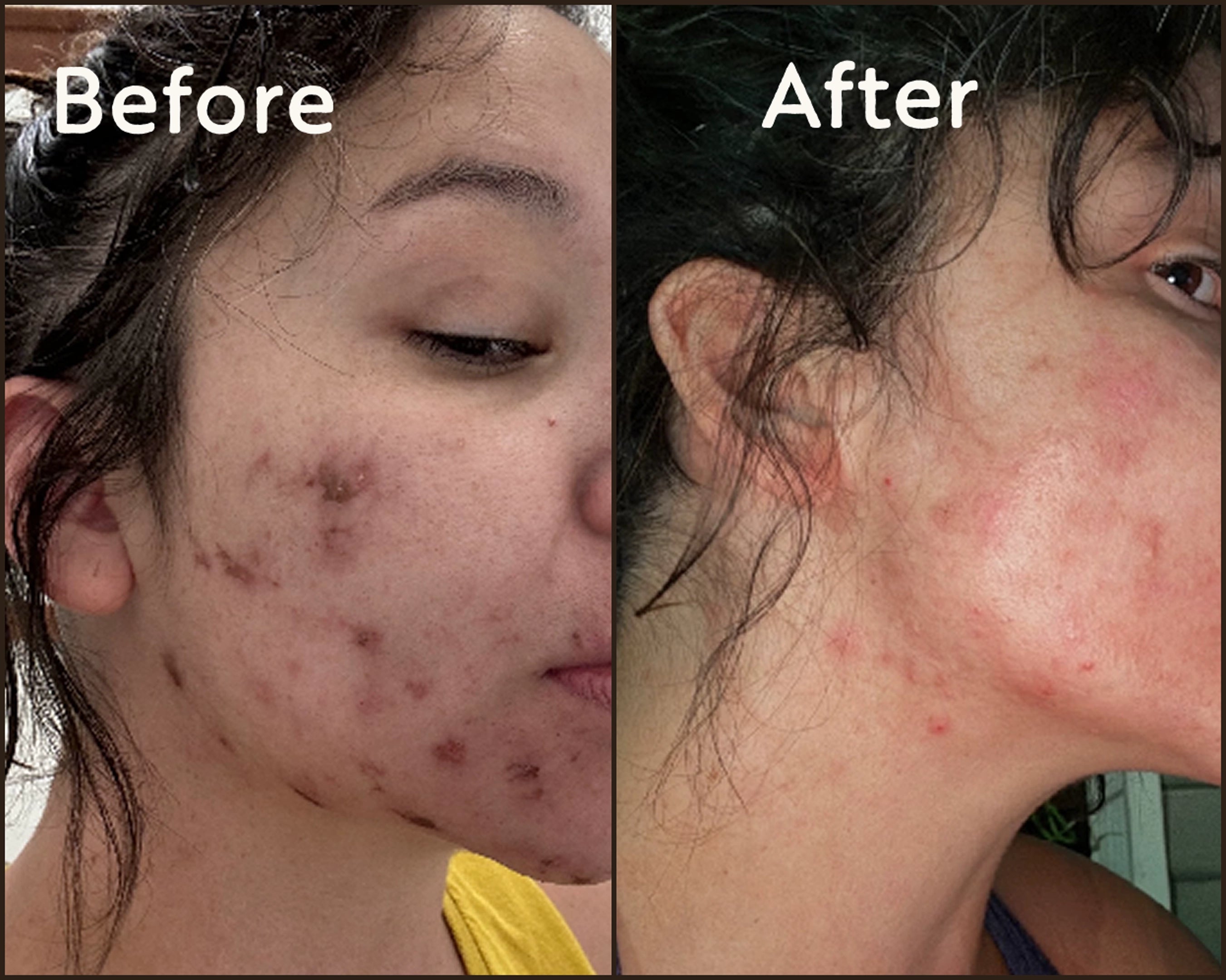 Before and after close-ups of cheek skin