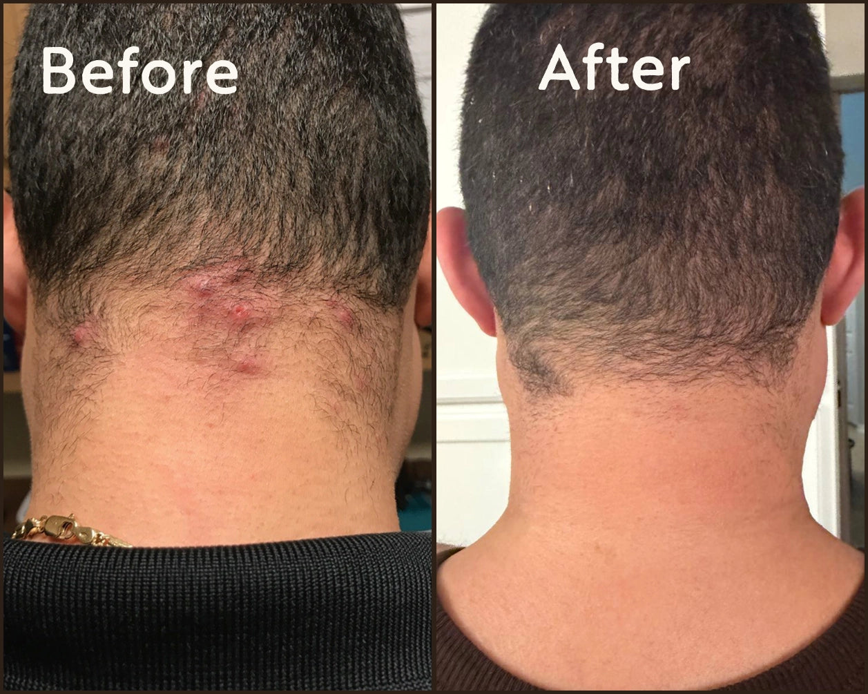 Before and after photos of the back of a man's neck